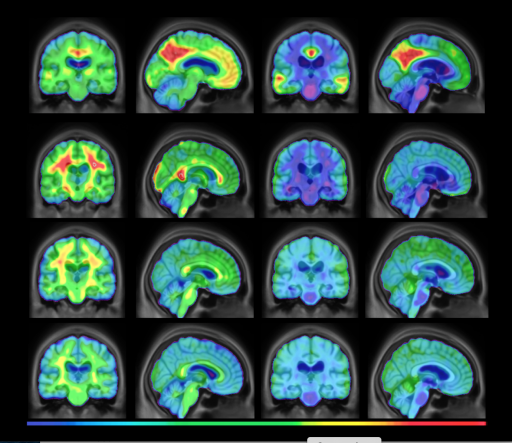 Over 41 million cases of dementia go undiagnosed across the globe ...